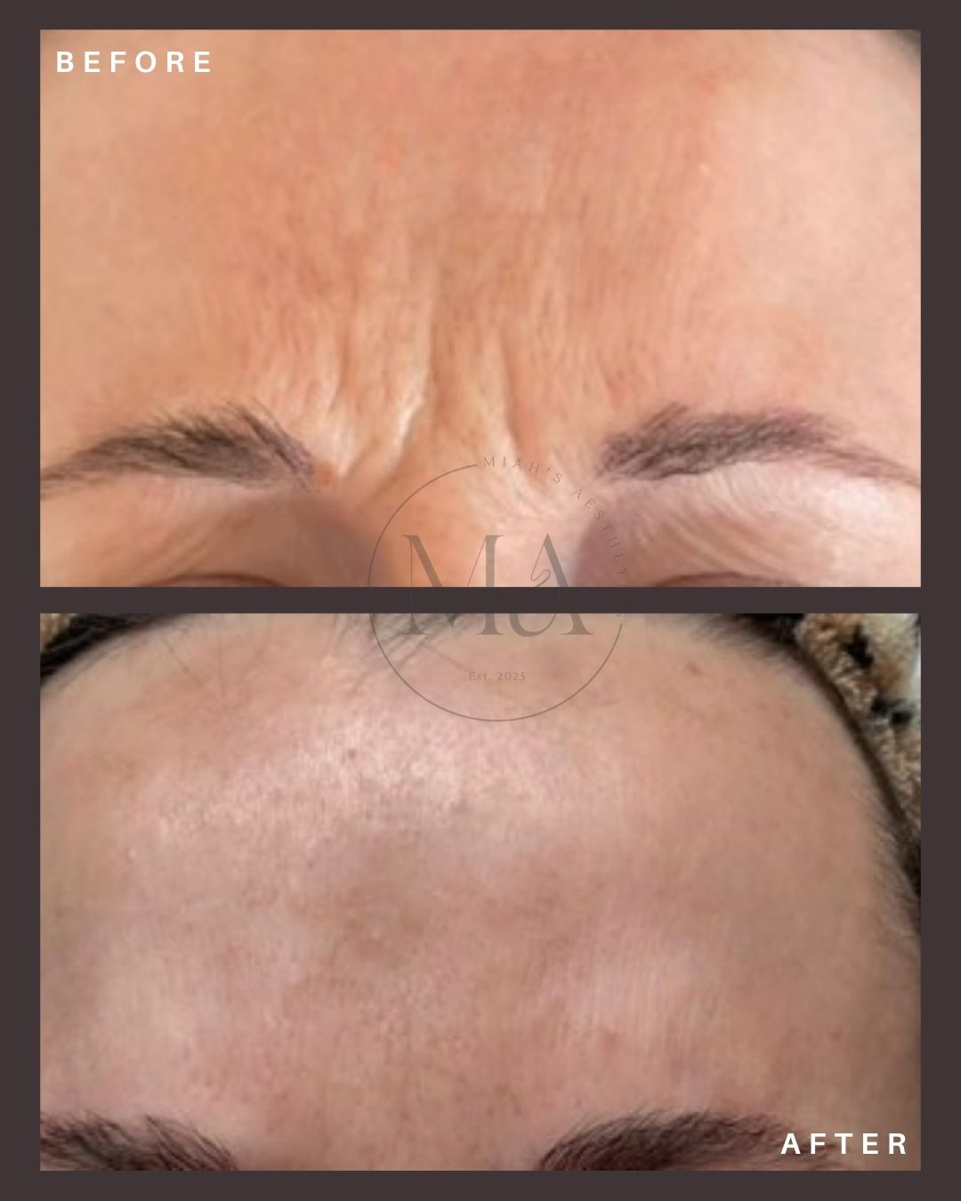 Anti wrinkle treamtment Eastbourne