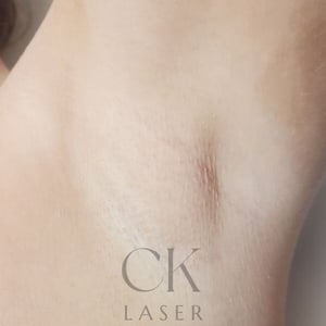 Laser Hair Removal Eastbourne