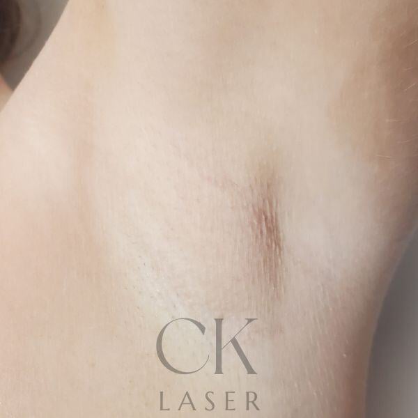 Underarms Before and After