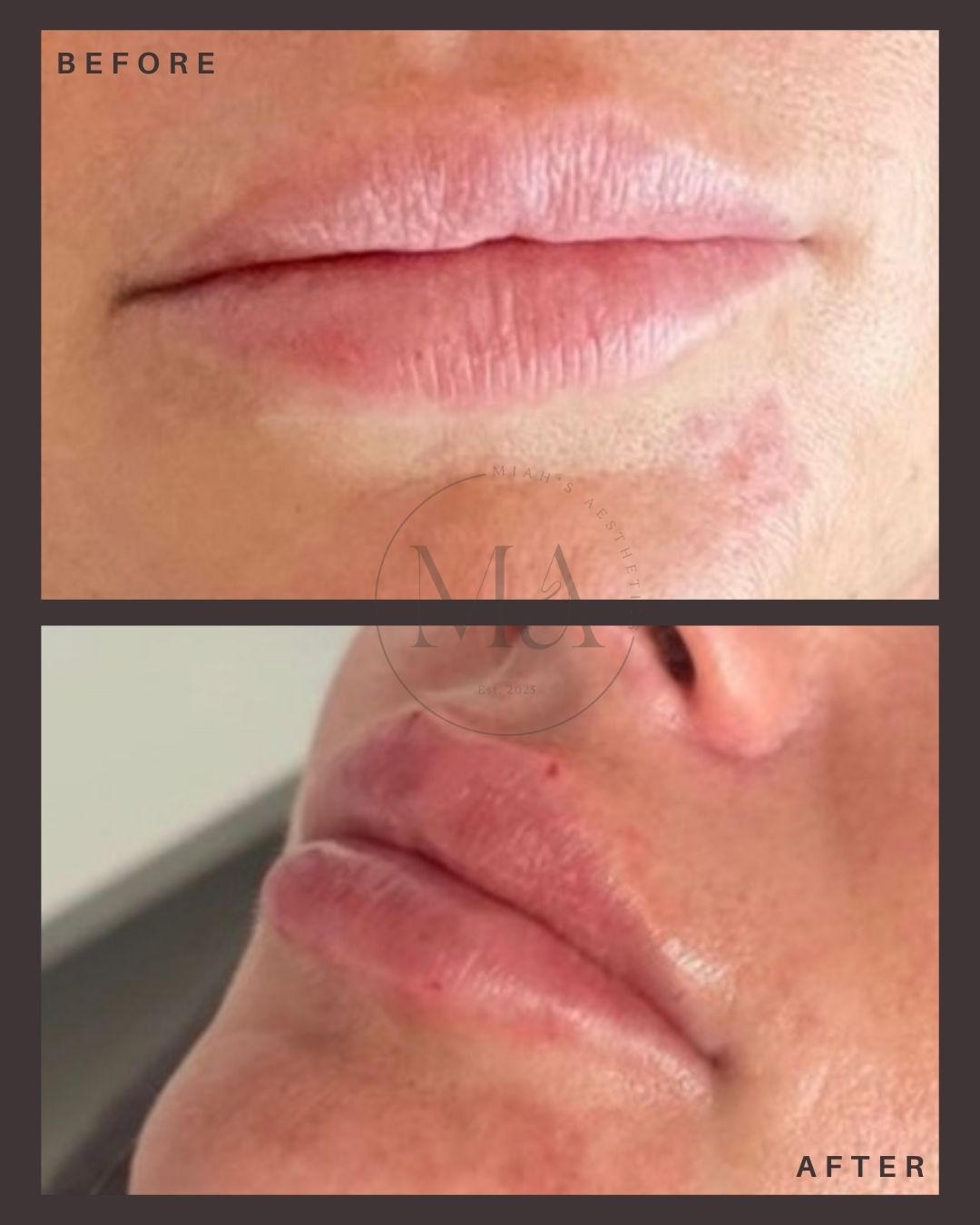 Lip Filler Eastbourne