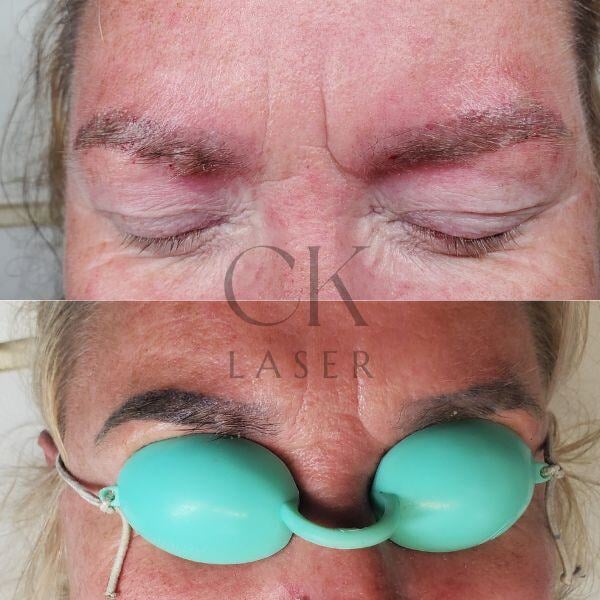 Tattoo Brow Removal Before and After