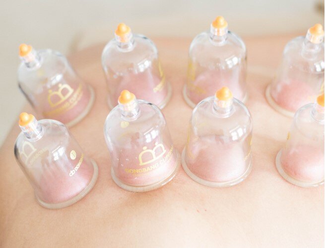 Cupping Therapy at Eastbourne Cupping Clinic